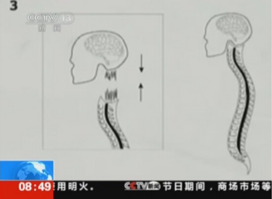 首例人類“換頭”手術(shù)將實(shí)施：比死還難受