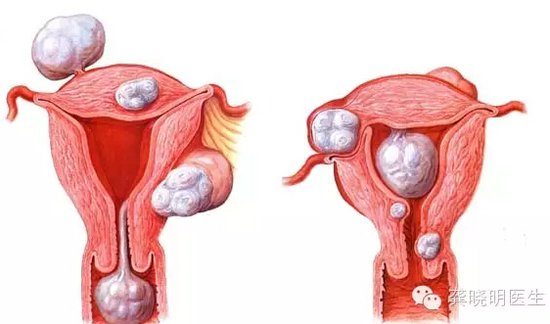 龔曉明：1/3女性都有的子宮肌瘤到底是啥