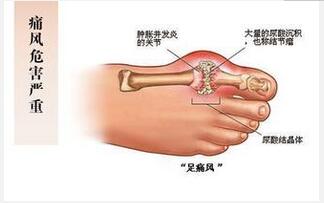 痛風(fēng)病人吃什么好？ 飲食需合理搭配