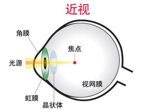 戴眼鏡會讓眼睛近視度數(shù)加深？