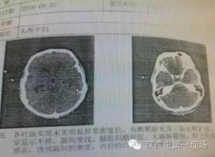 深圳男子被罕見(jiàn)“吃腦蟲”侵入 十幾天后病逝