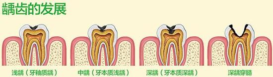 慎用牙簽？牙縫真的越剔越大嗎