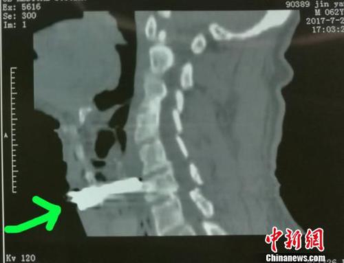 山西男子被砂輪直插咽喉傷口距頸動脈僅幾毫米