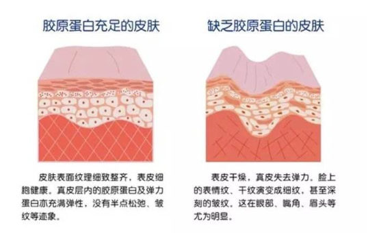 注射膠原蛋白真的能改善臉部皺紋？